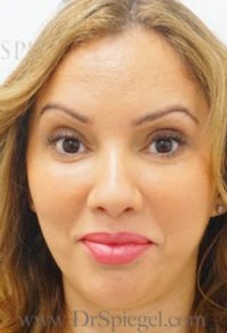 Botox / Dysport / Jeuveau / Xeomin Before & After Gallery - Patient 157140335 - Image 4