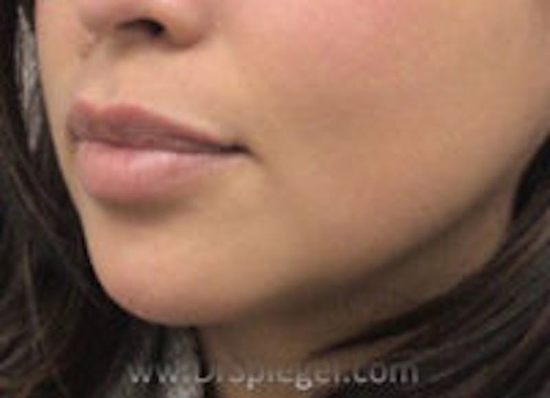 Chin Filler Before & After Gallery - Patient 157140334 - Image 4