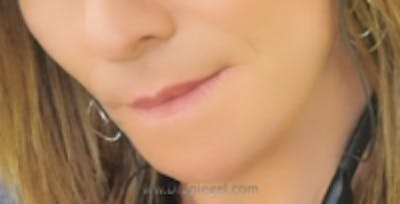 Mandible Contouring Before & After Gallery - Patient 157140337 - Image 2