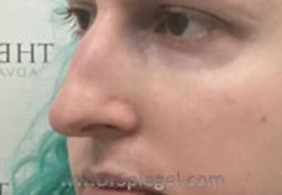 Rhinoplasty Before & After Gallery - Patient 157140338 - Image 1