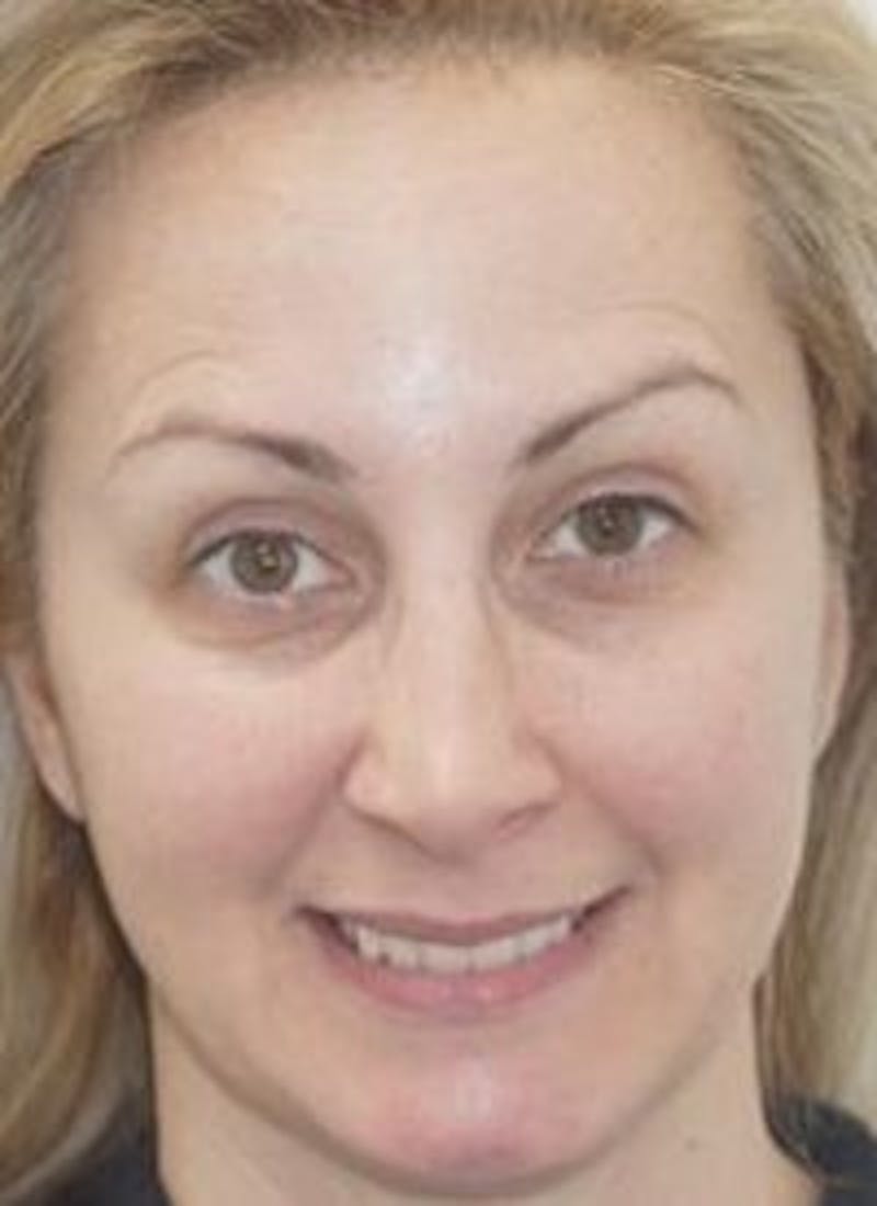 Liquid Face Lift Before & After Gallery - Patient 183935103 - Image 1