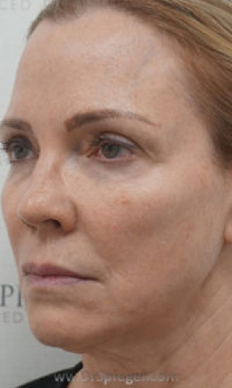 Facetite / Necktite / Embrace / Accutite Before & After Gallery - Patient 157140342 - Image 3