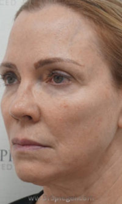 Facetite / Necktite / Embrace / Accutite Before & After Gallery - Patient 157140342 - Image 3
