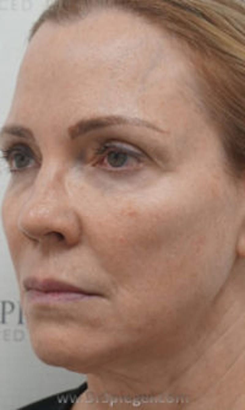 Facetite / Necktite / Embrace Before & After Gallery - Patient 157140342 - Image 3