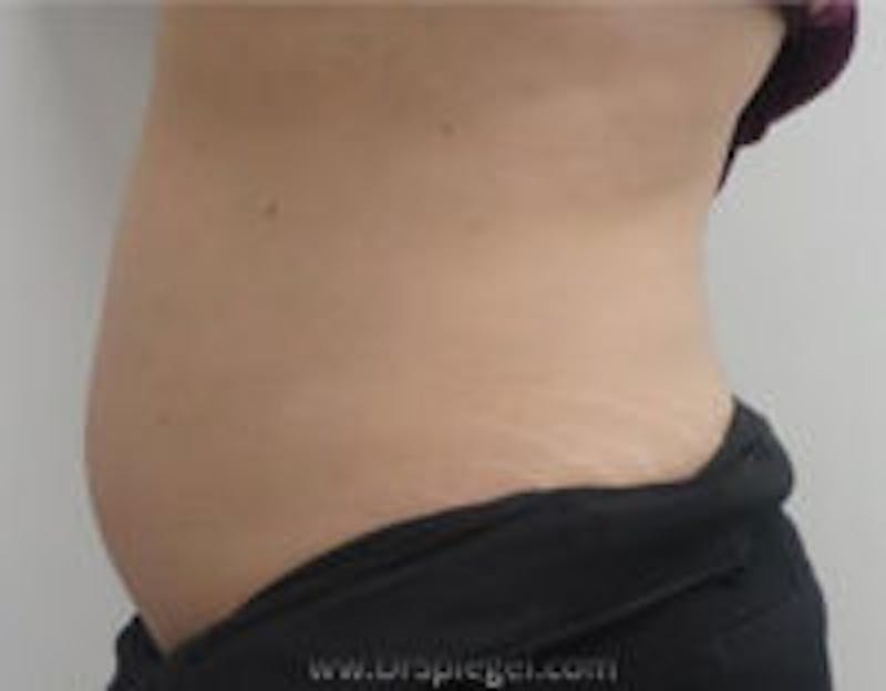 Fat Freezing Before & After Gallery - Patient 157140339 - Image 2