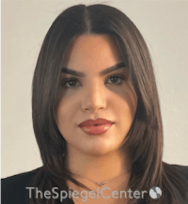 FFS Before & After Gallery - Patient 157140346 - Image 2