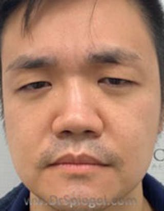 Botox / Dysport / Jeuveau / Xeomin Before & After Gallery - Patient 157140347 - Image 2