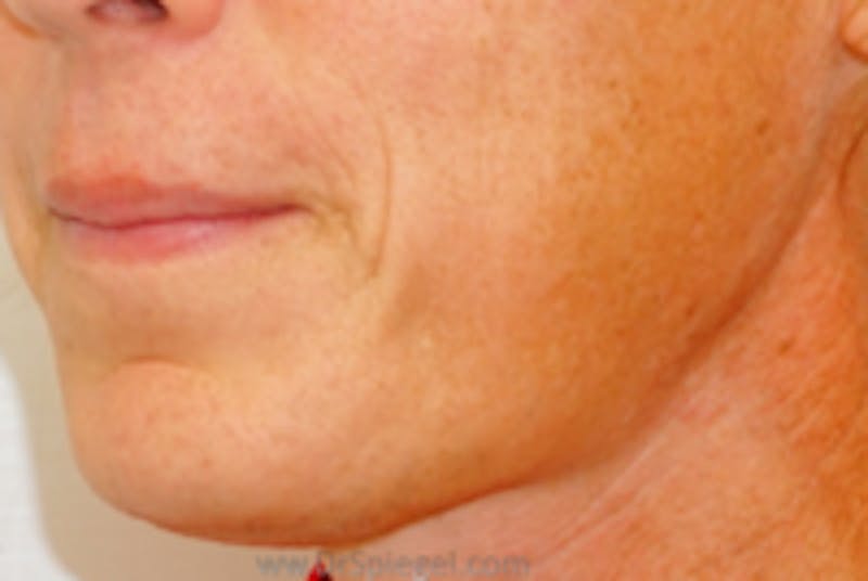 Mandible Contouring Before & After Gallery - Patient 157140343 - Image 1