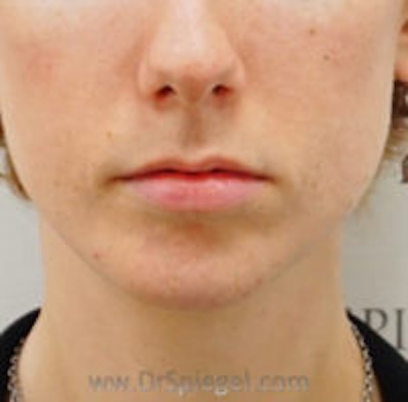Chin Filler Before & After Gallery - Patient 157140344 - Image 2