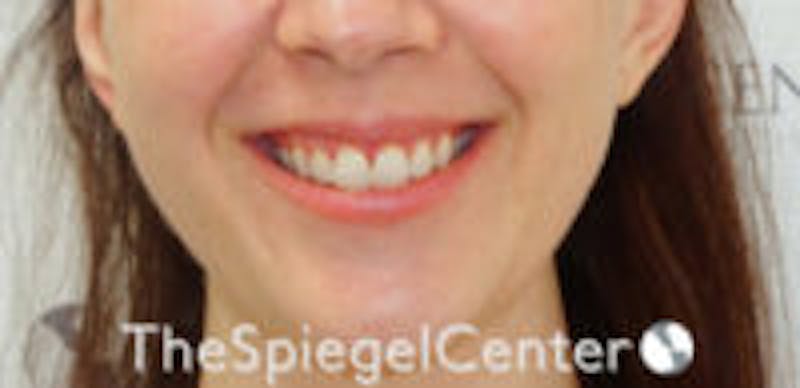 Gummy Smile Botox Before & After Gallery - Patient 157140348 - Image 1