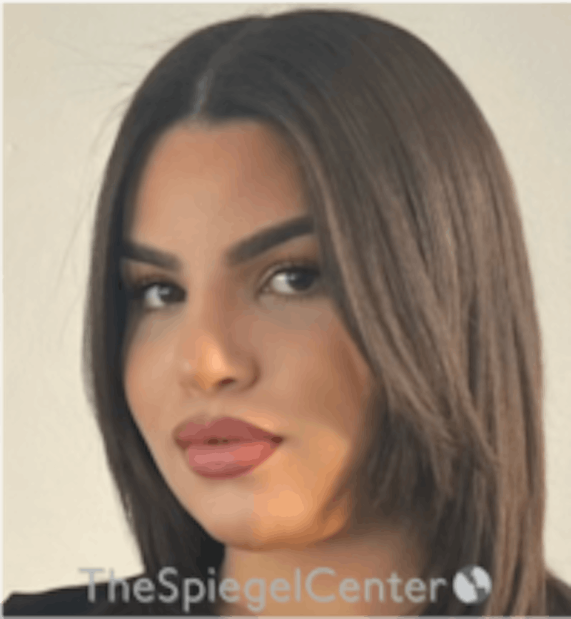 FFS Before & After Gallery - Patient 157140346 - Image 4