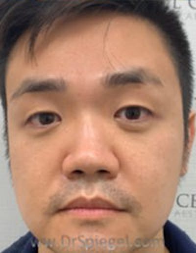 Botox / Dysport / Jeuveau / Xeomin Before & After Gallery - Patient 157140347 - Image 4