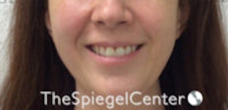 Gummy Smile Botox Before & After Gallery - Patient 157140348 - Image 2
