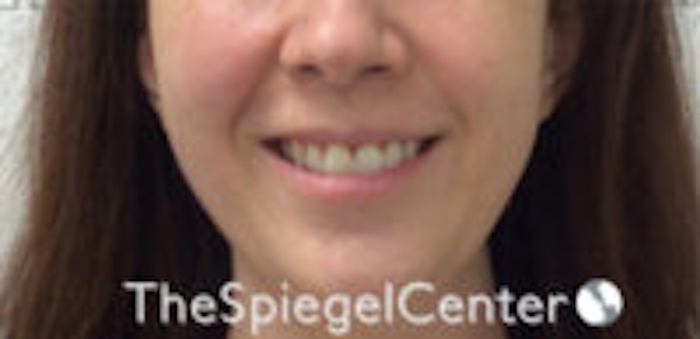 Gummy Smile Correction in Boston