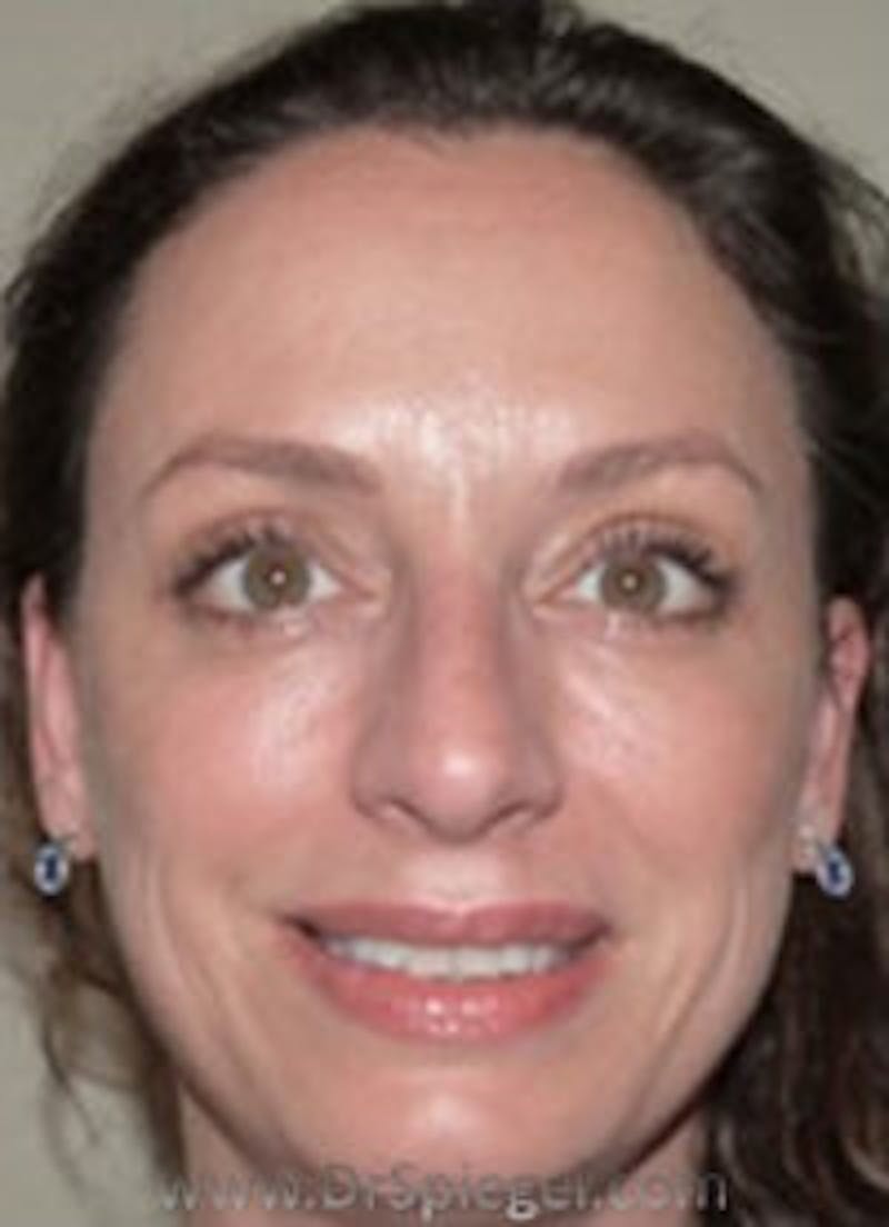Liquid Face Lift Before & After Gallery - Patient 183935104 - Image 2