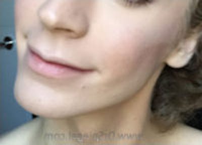 Mandible Contouring Before & After Gallery - Patient 157140352 - Image 1