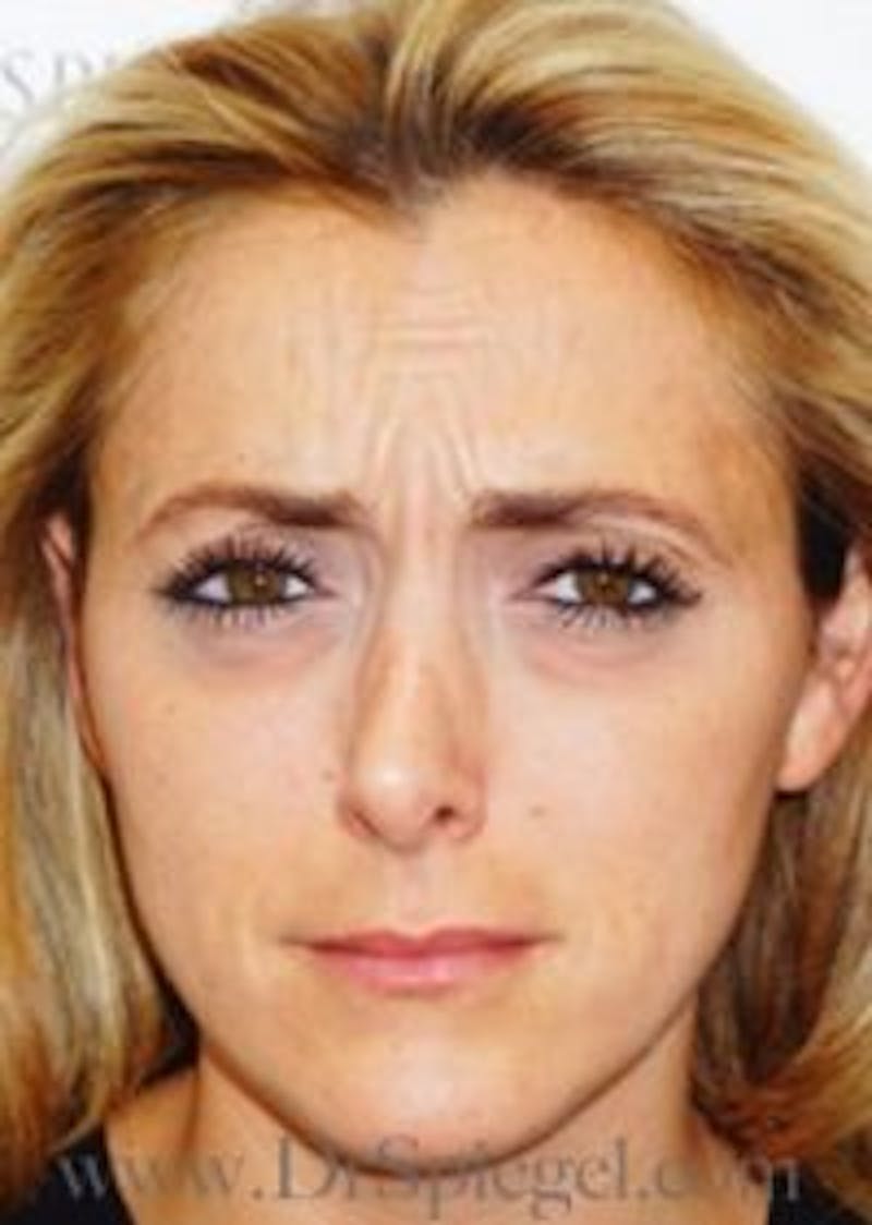 Botox / Dysport / Jeuveau / Xeomin Before & After Gallery - Patient 157140363 - Image 1