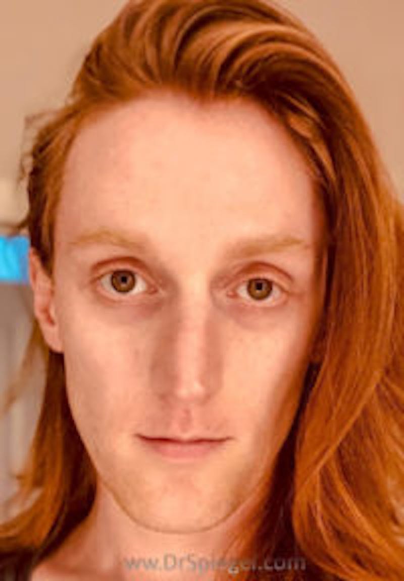FFS Before & After Gallery - Patient 157140361 - Image 1