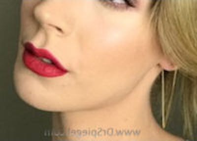 Mandible Contouring Before & After Gallery - Patient 157140352 - Image 2