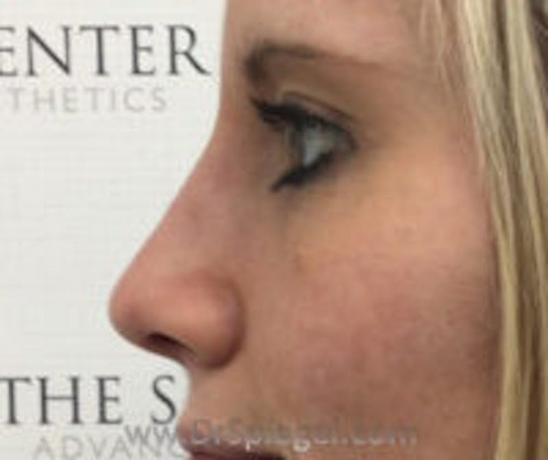Rhinoplasty Before & After Gallery - Patient 157140353 - Image 2