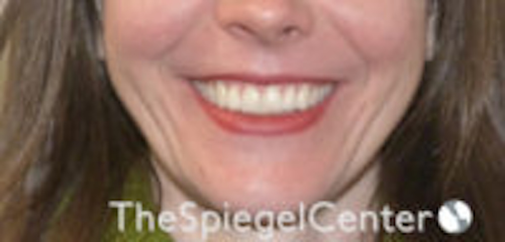 Gummy Smile Correction