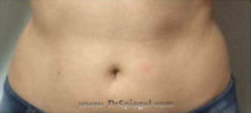 Fat Freezing Before & After Gallery - Patient 157140354 - Image 2