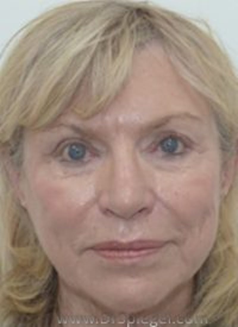 Liquid Face Lift Before & After Gallery - Patient 183935105 - Image 1