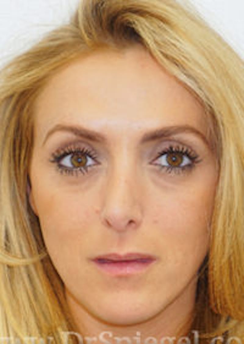 Botox / Dysport / Jeuveau / Xeomin Before & After Gallery - Patient 157140363 - Image 2