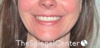 Gummy Smile Botox Before & After Gallery - Patient 157140355 - Image 2