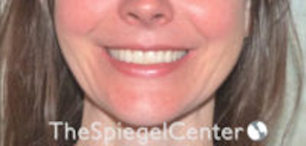 Gummy Smile Correction