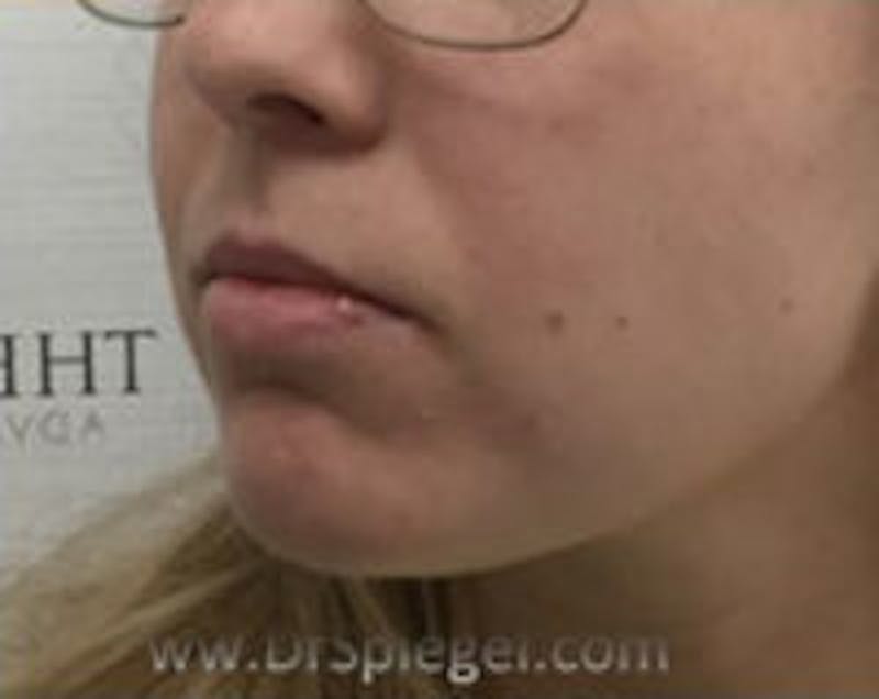Chin Filler Before & After Gallery - Patient 157140359 - Image 3