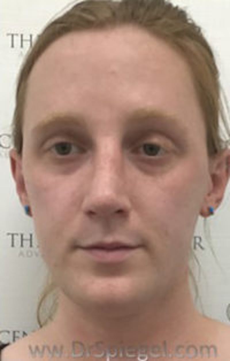 FFS Before & After Gallery - Patient 157140361 - Image 3