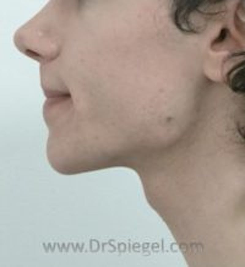 Mandible Contouring Before & After Gallery - Patient 157140360 - Image 1