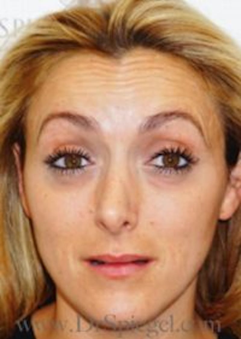 Botox / Dysport / Jeuveau / Xeomin Before & After Gallery - Patient 157140363 - Image 3
