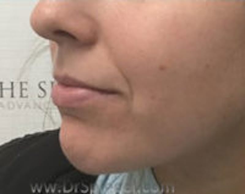 Chin Filler Before & After Gallery - Patient 157140359 - Image 4