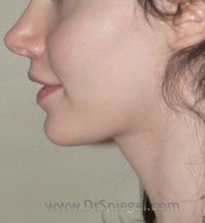 Mandible Contouring Before & After Gallery - Patient 157140360 - Image 2