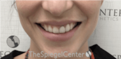 Gummy Smile Botox Before & After Gallery - Patient 157140364 - Image 1