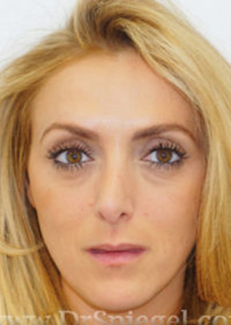 Botox / Dysport / Jeuveau / Xeomin Before & After Gallery - Patient 157140363 - Image 4