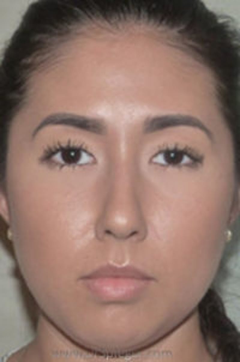 Liquid Face Lift Before & After Gallery - Patient 183935106 - Image 1
