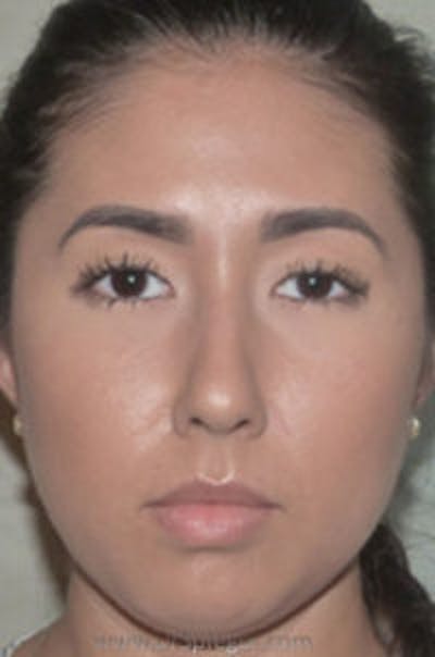 Liquid Face Lift Before & After Gallery - Patient 183935106 - Image 1
