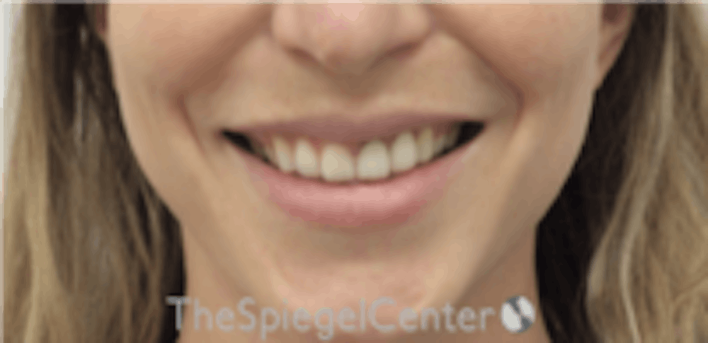 Gummy Smile Correction