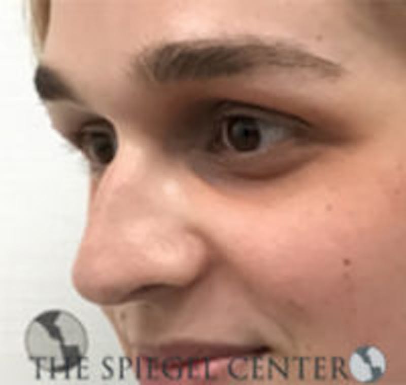 Rhinoplasty Before & After Gallery - Patient 157140367 - Image 1