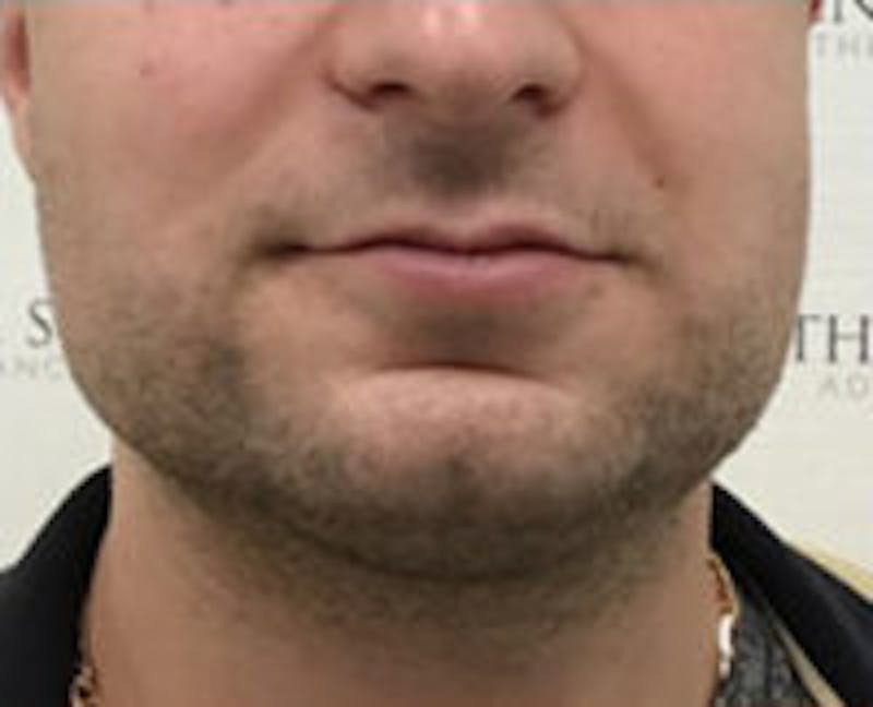 Facetite / Necktite / Embrace / Accutite Before & After Gallery - Patient 157140374 - Image 2