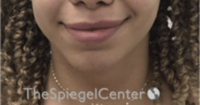 Chin Filler Before & After Gallery - Patient 157140381 - Image 1