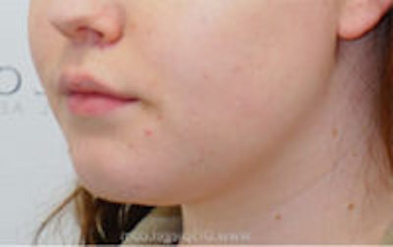 Mandible Contouring Before & After Gallery - Patient 157140368 - Image 1