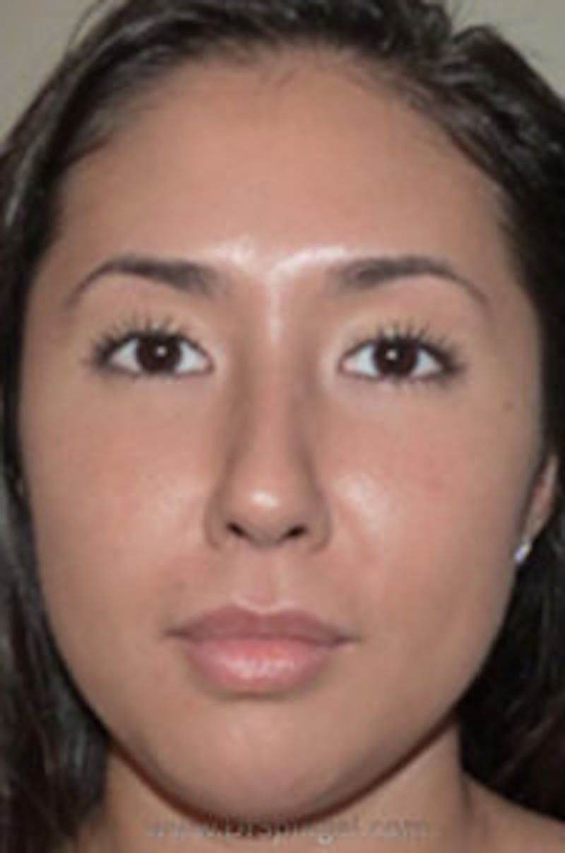 Liquid Face Lift Before & After Gallery - Patient 183935106 - Image 2