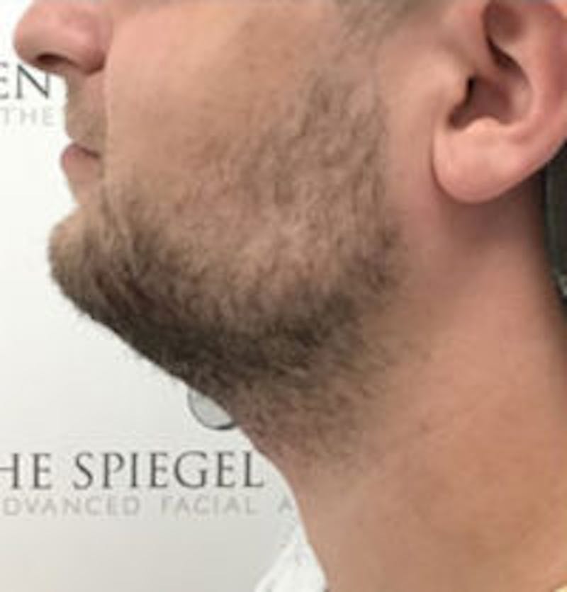 Facetite / Necktite / Embrace / Accutite Before & After Gallery - Patient 157140374 - Image 3