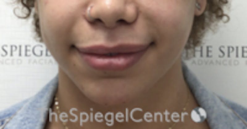 Chin Filler Before & After Gallery - Patient 157140381 - Image 2