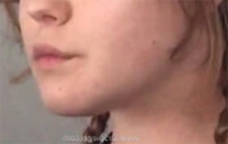 Mandible Contouring Before & After Gallery - Patient 157140368 - Image 2
