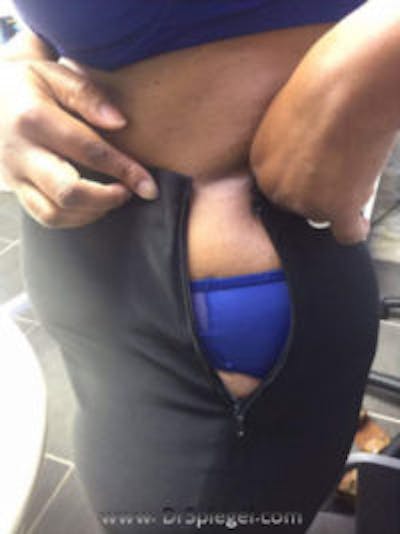 Fat Freezing Before & After Gallery - Patient 157140375 - Image 2